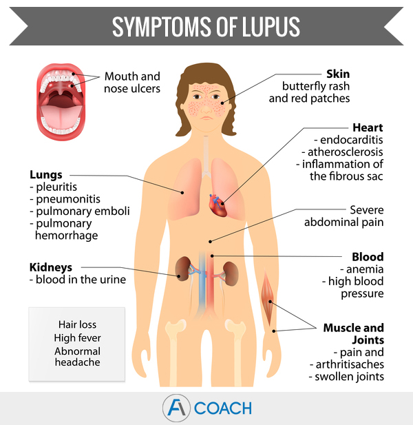 Lupus Fatigue